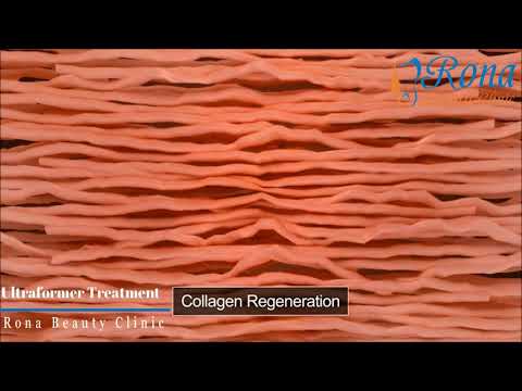 Ultraformer  HIFU For Face