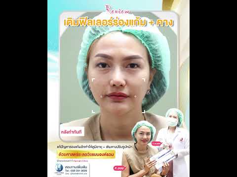 รีวิวหัตถการโปรแกรมปรับรูปหน้าแบบองค์รวม