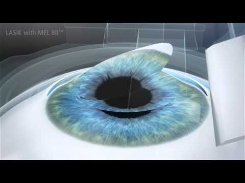 LASIK Microkératôme : la chirurgie des yeux au laser (1990)