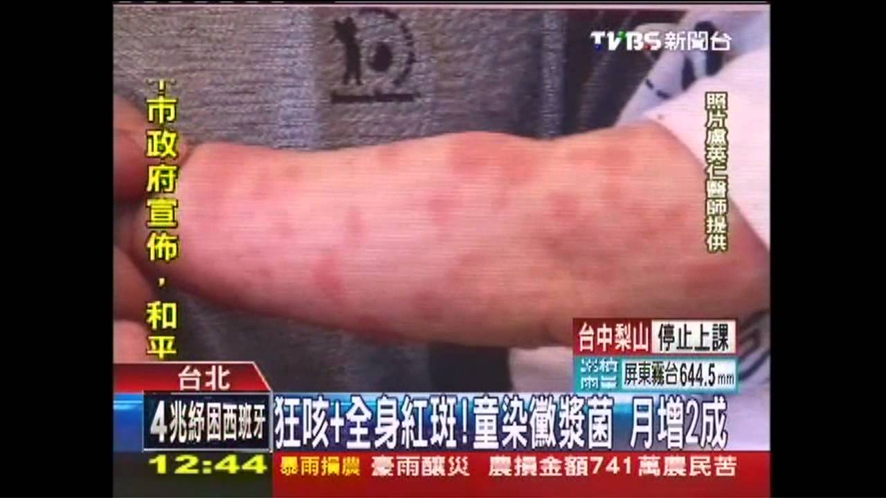 狂咳+全身紅斑！童染黴漿菌　月增2成
