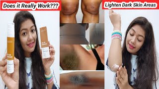 Treat Acanthosis Nigricans?? | Reduce Darkness of Elbow, Knees, Nack, Under Arms || Krrish Sarkar