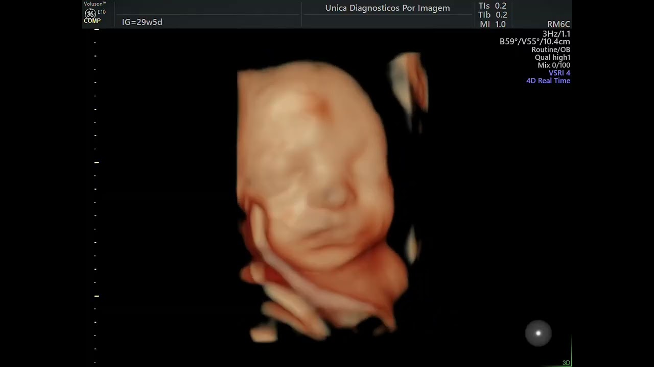 Ultrassom 4D HD Live 29 semanas de gestação