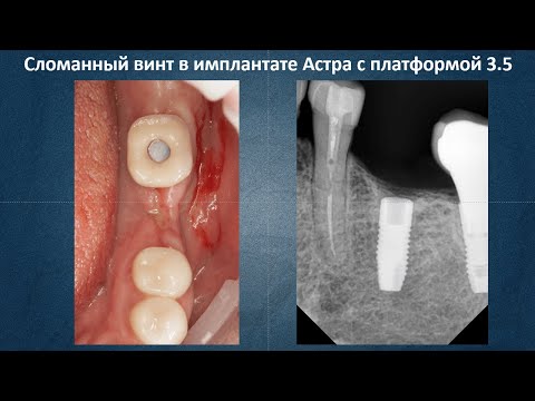 Удаление сломанного винта из имплантата Астра 3 5