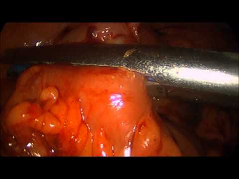 Resección laparoscópica de divertículo de Meckel por diverticulitis aguda
