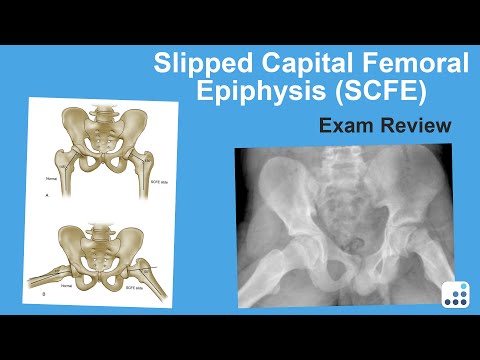 Slipped Capital Femoral Epiphysis (SCFE) Exam Review - William Jiranek, MD