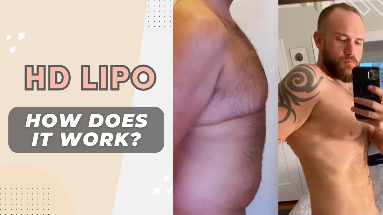 HD Lipo: What is it & who is it for? Plastic Surgeon Explains