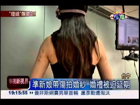 埋線爛膿包! 準新娘帶傷拍婚紗
