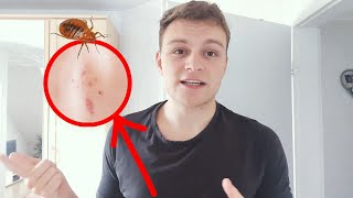 Bed Bug Bites Treatment for Healing (What worked for me)