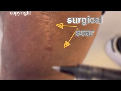 STD Knee pain surgery joint arthritis by urethritis NGU NCNGU UTI Dr Aran , Right DX prevent surgery