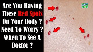 Are You Having These Red Spots On Your Body ? Need To Worry ? When To See A Doctor ?