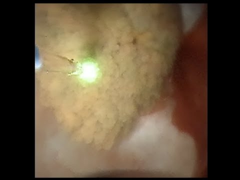 RIRS FOR KIDNEY STONES WITH REVOLIX HTL unedited