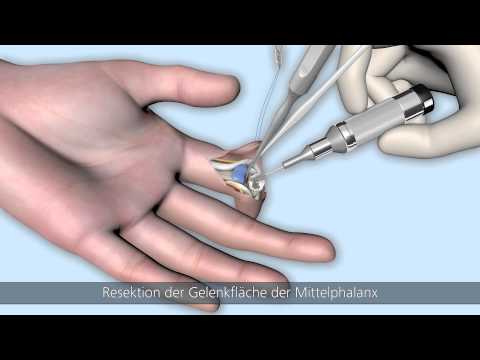 CapFlex PIP – Endoprothetische Versorgung des proximalen Interphalangealgelenks (palmarer Zugang)