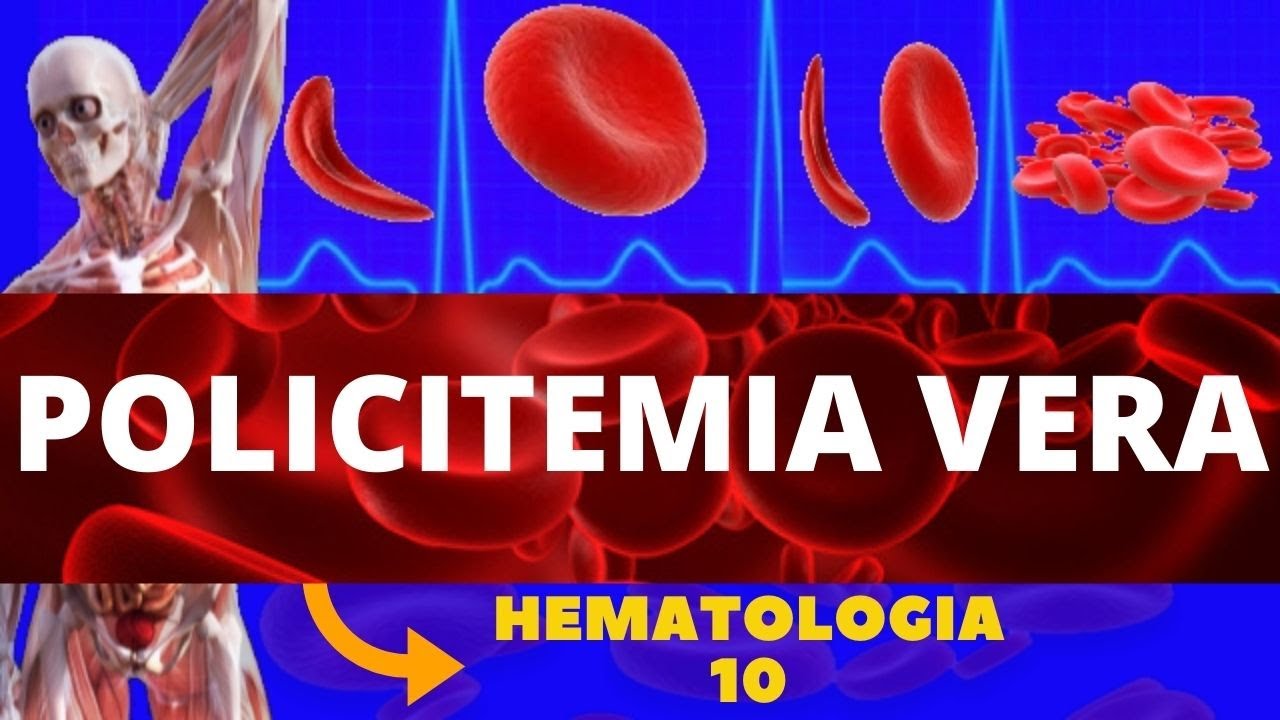 POLICITEMIA VERA (DOENÇA MIELOPROLIFERATIVA) - HEMATOLOGIA
