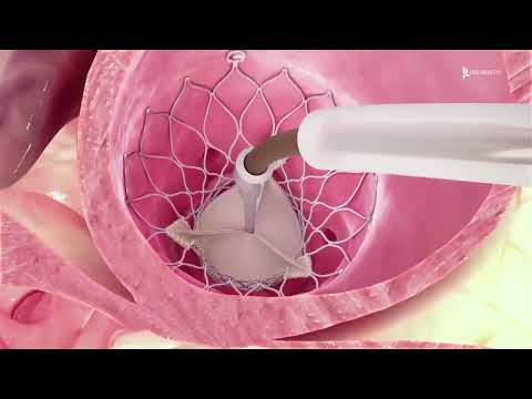 Treatments for Aortic Stenosis