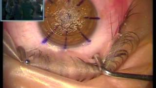 Download Lagu Thermokeratoplasty and PK Hydrops keratoconus treatment Thumbnail