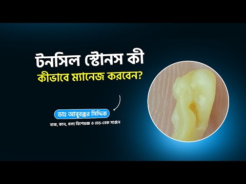 টনসিল স্টোনস কী? কীভাবে ম্যানেজ করবেন?