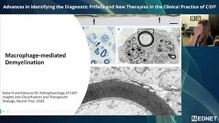 CIDP Diagnosis and Treatment: Diagnostic Pitfalls and New Therapies | CME Webcast