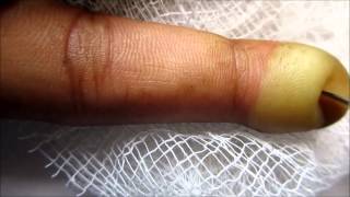 Index Finger Blister Popping