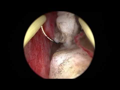 Prostata-Hyperplasie Anulingus mit Prostata-Massage