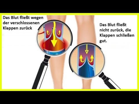 Behandlung von Prostatitis cinquefoil Serratia-Spezies in Prostatasekret