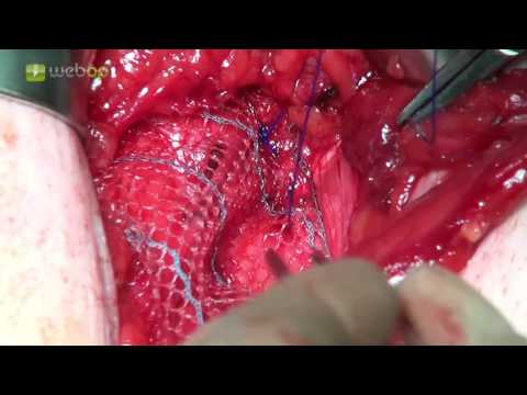 Halswirbelverdrängungsbehandlungsscheiben Chirurgie Knieersatz, wenn Sie nicht tun