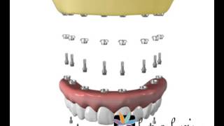 Implante - Protocolo superior e inferior