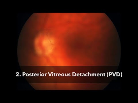 Posterior Vitreous Detachment (PVD)