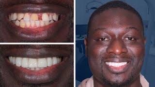 Invisalign and Composite Bonding in Lancashire with Dr. Arnold