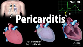 Pericarditis: Symptoms, Pathophysiology, Causes, Diagnosis and Treatments, Animation