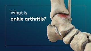 What is ankle arthritis?
