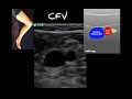 POCUS Lower Extremity Deep Venous Thrombosis DVT Updated