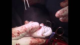 Download Lagu Hybrid Aortic Type I Dissection Repair Thumbnail
