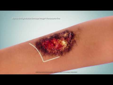 integra dermal regeneration template thin animation fr