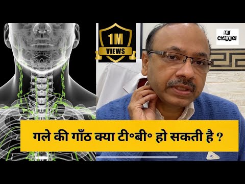 गर्दन की गाँठ- टी॰बी॰ या कैन्सर तो नहीं? Neck node swelling
