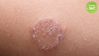 What is Ringworm, and How do we Treat It? - Australia 360