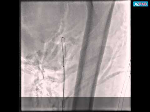 Combined Antegrade and Retrograde Ostial SFA Cross