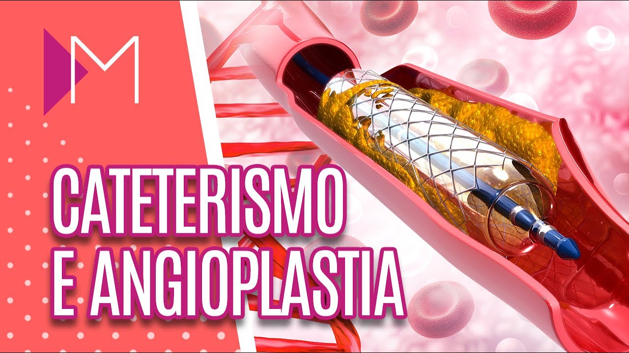 Cateterismo e angioplastia: tire suas dúvidas - Mulheres (09/10/19)