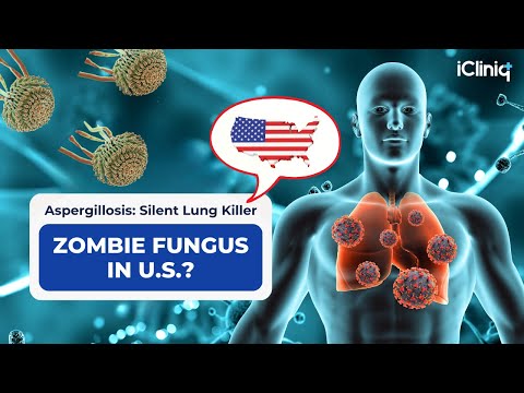 Zombie Fungus in the U.S.? Aspergillosis Outbreak Explained (2025) | iCliniq | US