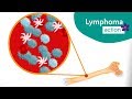 What Is Chronic Lymphocytic Leukaemia CLL Small Lymphocytic Lymphoma SLL