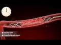 Mechanical Thrombectomy Neurovascular Stent Deployment