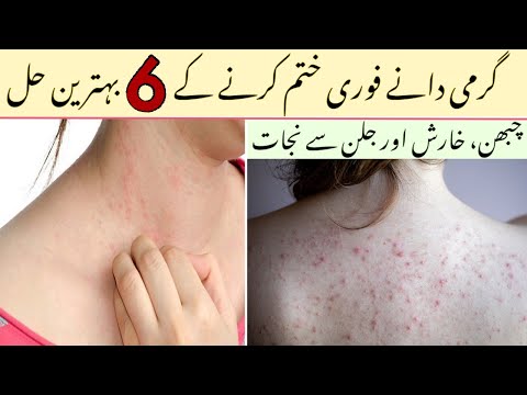 How to get rid of heat rash - Treatment for heat rash - Treatment for heat rash and itching