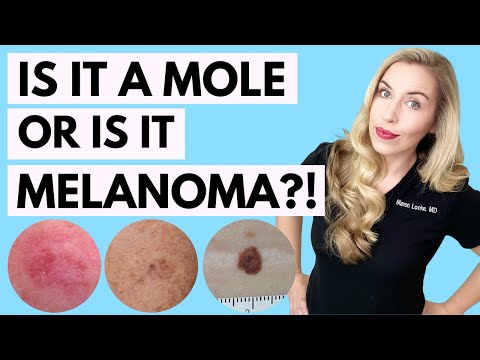 Is It A Mole or Melanoma? This Might Save Your Life! | Dermatologist Tips