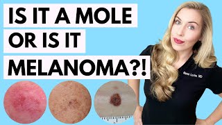Is It A Mole or Melanoma? This Might Save Your Life! | Dermatologist Tips