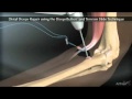 Distal Biceps Repair Animation