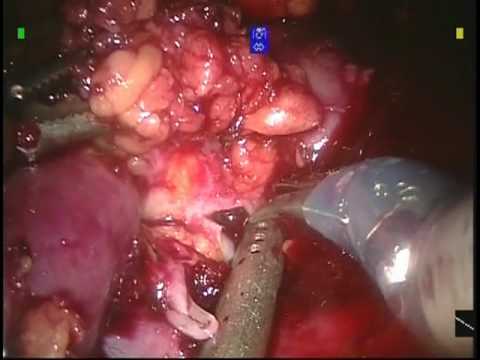 Complications After Nephron Saving Procedure-Robotically Assissted And Laparoscopic.
