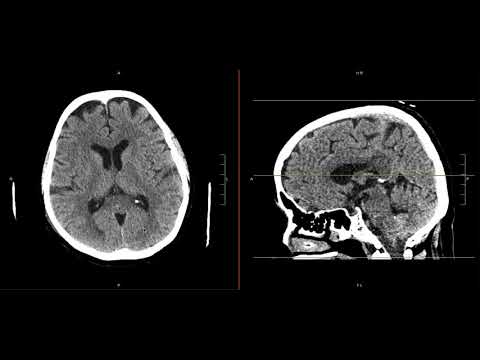Intracranial Contents Part 2 (Ventricular System)
