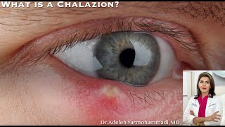 What is a Chalazion? "What is that red bump on my eyelid?"