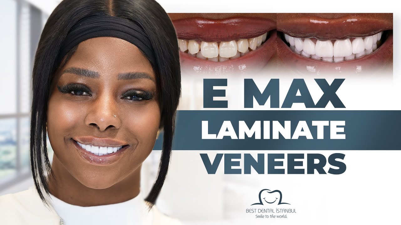 Asisat's Emax Veneers Journey: Best Dental Istanbul Experience