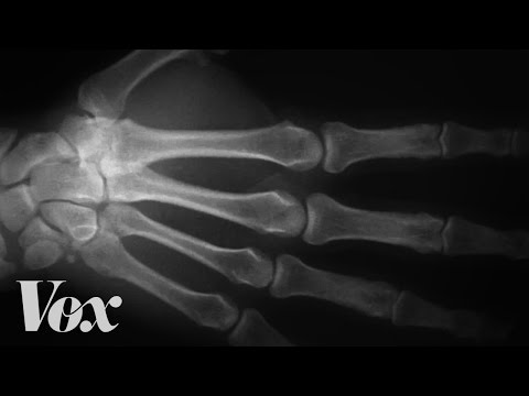 Here's what happens to your knuckles when you crack them