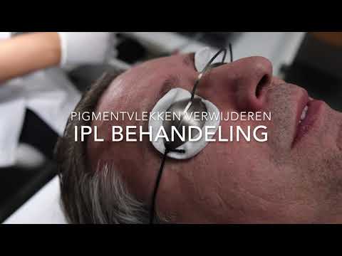 Carrousel video: IPL behandeling tegen pigmentvlekken